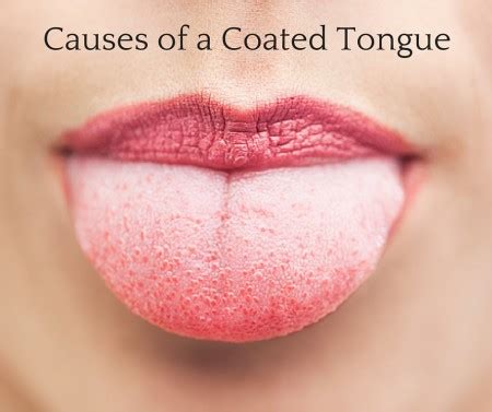 White coated tongue is as result of an overgrowth and swelling of papillae on the surface of the tongue. . Pictures of brown coated tongue